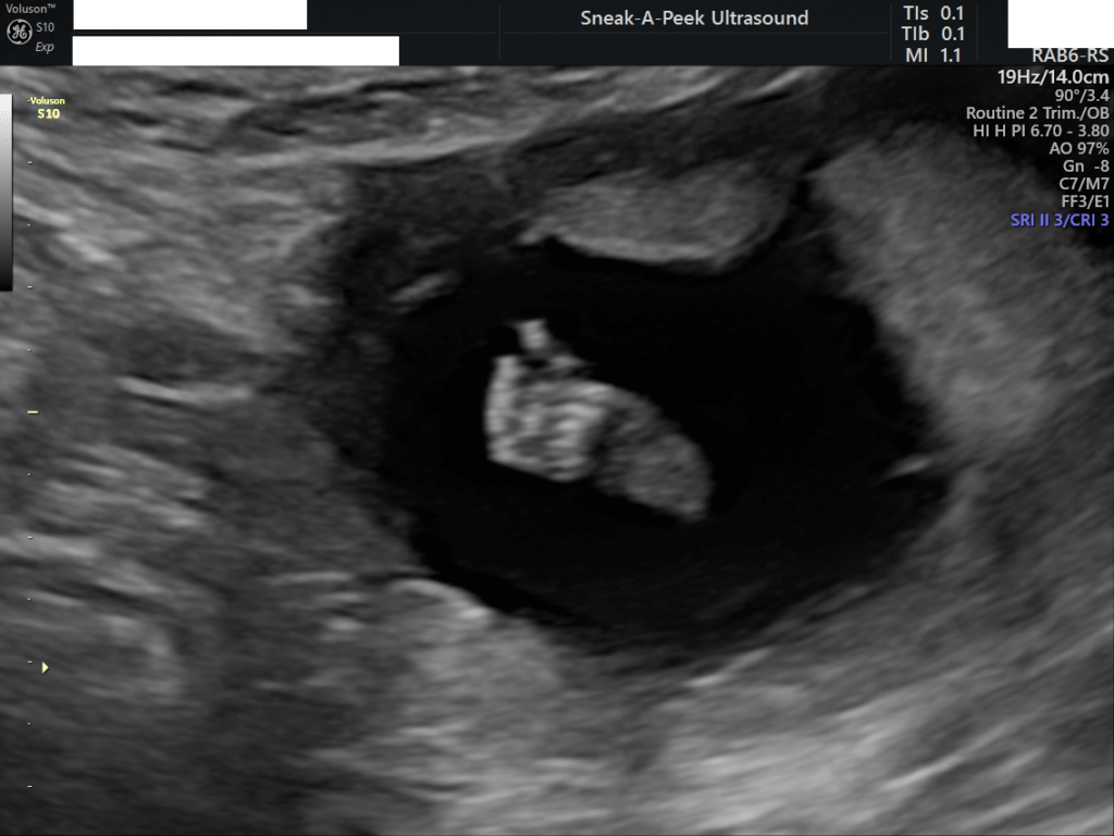 List of baby scans at sneak a peek ultrasound