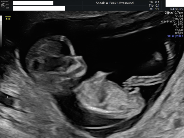 Early Pregnancy Scans Sneak A Peek Ultrasound 3996