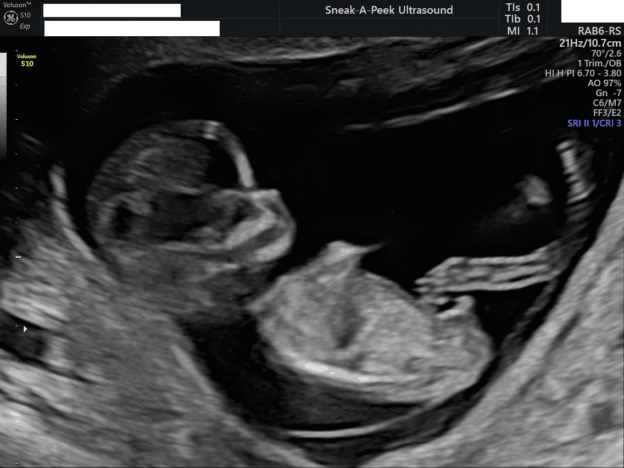 Early Pregnancy Scans | Sneak-A-Peek Ultrasound