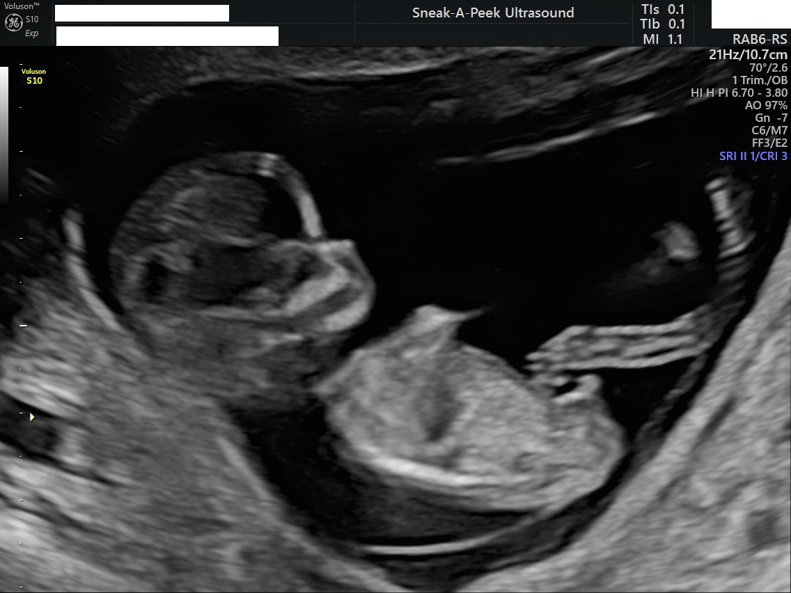 12-week appointment? your ultrasound happens what at 12 Things